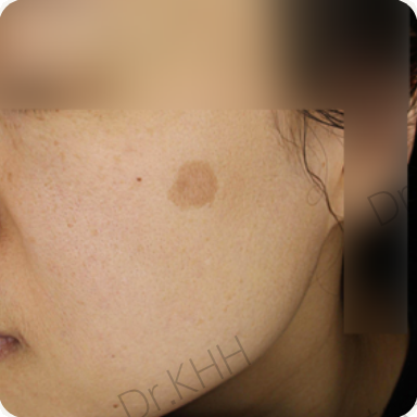 Before treatment