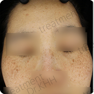 Before treatment