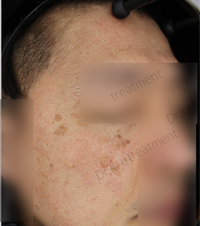Before treatment