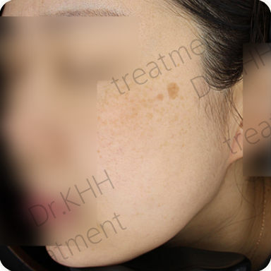 Before treatment