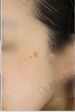 Before treatment
