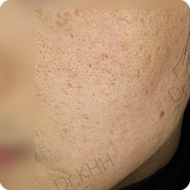 Before treatment