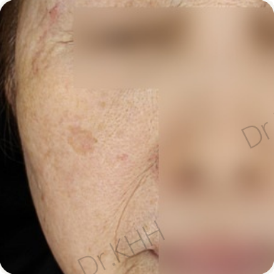 Before treatment