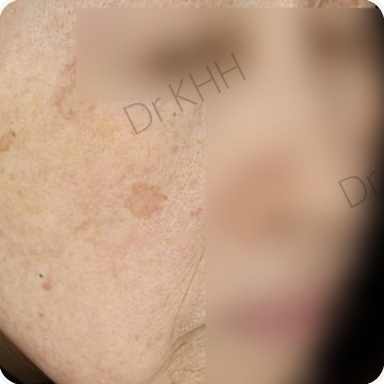 Before treatment