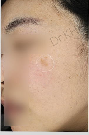 Before treatment
