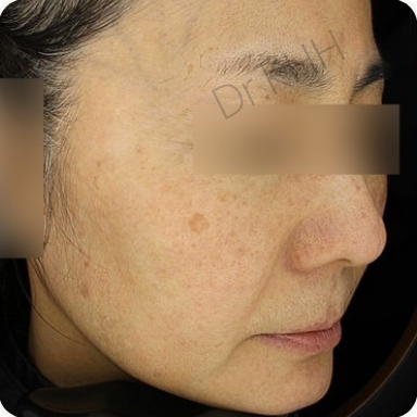 Before treatment