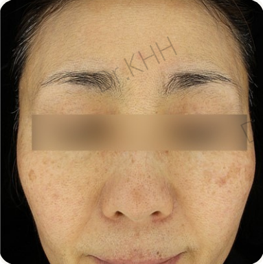 Before treatment