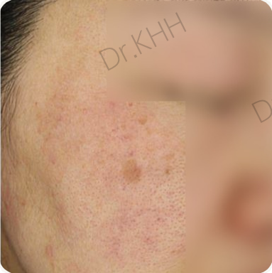Before treatment