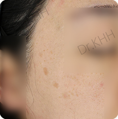 Before treatment