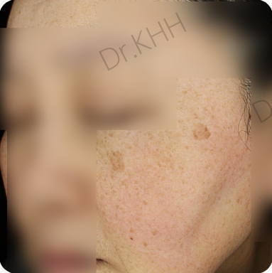 Before treatment