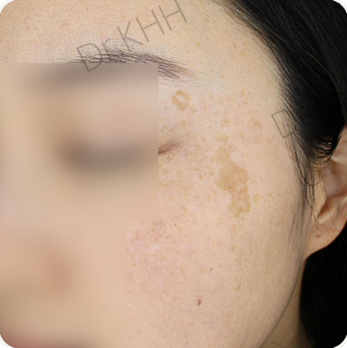 Before treatment