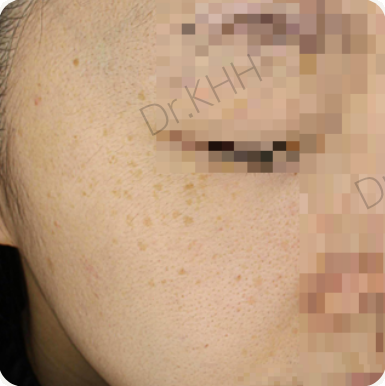 Before treatment
